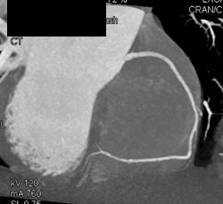 Normal Left Anterior Descending Coronary Artery (LAD) and Right Coronary Artery (RCA) - CTisus CT Scan