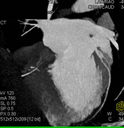 Normal Left Anterior Descending Coronary Artery (LAD) and Right Coronary Artery (RCA) - CTisus CT Scan