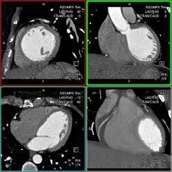 Normal Left Anterior Descending Coronary Artery (LAD) and Right Coronary Artery (RCA) - CTisus CT Scan