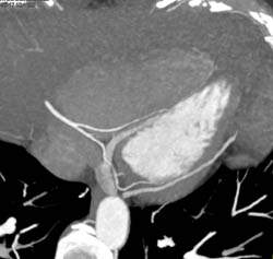 Normal Left Anterior Descending Coronary Artery (LAD) and Right Coronary Artery (RCA) - CTisus CT Scan