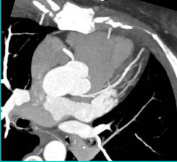 Normal Left Anterior Descending Coronary Artery (LAD) and Right Coronary Artery (RCA) - CTisus CT Scan