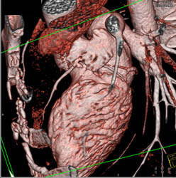 Normal Left Anterior Descending Coronary Artery (LAD) and Right Coronary Artery (RCA) - CTisus CT Scan