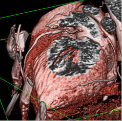 Normal Left Anterior Descending Coronary Artery (LAD) and Right Coronary Artery (RCA) - CTisus CT Scan