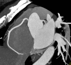 Normal Left Anterior Descending Coronary Artery (LAD) and Right Coronary Artery (RCA) - CTisus CT Scan