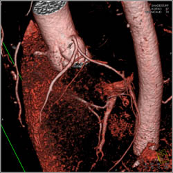 Normal Left Anterior Descending Coronary Artery (LAD) Bifurcation - CTisus CT Scan