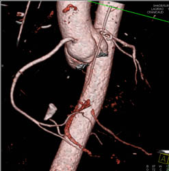 Normal Right Coronary Artery (RCA) - CTisus CT Scan