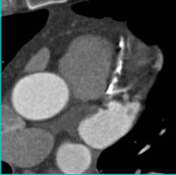 Left Anterior Descending Coronary Artery (LAD) Disease - CTisus CT Scan