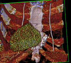 Calcified Pericardium - CTisus CT Scan