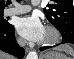 Calcified Pericardium - CTisus CT Scan