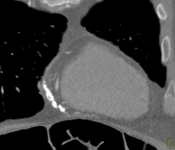 Pericardial Calcification - CTisus CT Scan