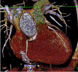 Normal Left Anterior Descending Coronary Artery (LAD) in Various Renderings - CTisus CT Scan