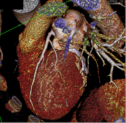 Normal Left Anterior Descending Coronary Artery (LAD) in Various Renderings - CTisus CT Scan