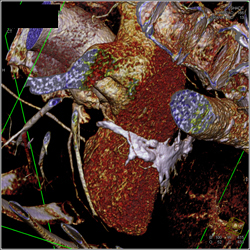 Normal Left Anterior Descending Coronary Artery (LAD) in Various Renderings - CTisus CT Scan