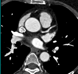 Left Anterior Descending Coronary Artery (LAD) Plaque - CTisus CT Scan