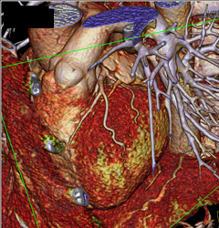 Normal Left Anterior Descending Coronary Artery (LAD) in Various Renderings - CTisus CT Scan