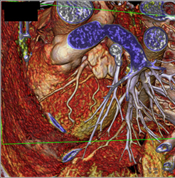 Normal Left Anterior Descending Coronary Artery (LAD) in Various Renderings - CTisus CT Scan