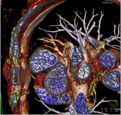 Normal Left Anterior Descending Coronary Artery (LAD) in Various Renderings - CTisus CT Scan