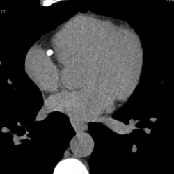 Stent in Right Coronary Artery (RCA) - CTisus CT Scan