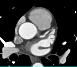 Soft Plaque in Left Anterior Descending Coronary Artery (LAD) - CTisus CT Scan