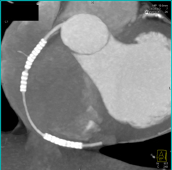 Stent in Right Coronary Artery (RCA) - CTisus CT Scan