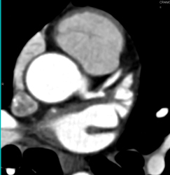 Calcified and Noncalcified Lca Plaque - CTisus CT Scan