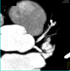 Calcified and Noncalcified Lca Plaque - CTisus CT Scan