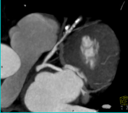 Calcified and Noncalcified Lca Plaque - CTisus CT Scan