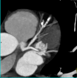 Calcified and Noncalcified Lca Plaque - CTisus CT Scan