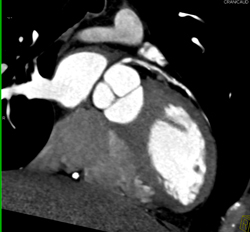 Calcified and Noncalcified Lca Plaque - CTisus CT Scan