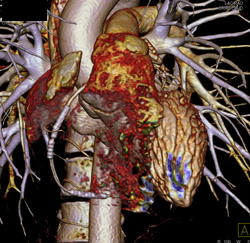 Stent in Right Coronary Artery (RCA) - CTisus CT Scan