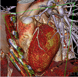 Minimal Left Anterior Descending Coronary Artery (LAD) Disease - CTisus CT Scan