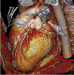 Minimal Left Anterior Descending Coronary Artery (LAD) Disease - CTisus CT Scan