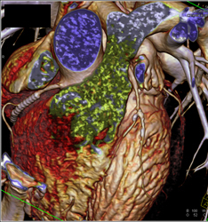 Stent in Right Coronary Artery (RCA) - CTisus CT Scan