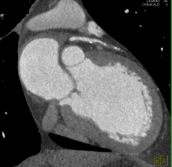 Minimal Left Anterior Descending Coronary Artery (LAD) Disease - CTisus CT Scan