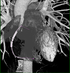 Stent in Right Coronary Artery (RCA) - CTisus CT Scan