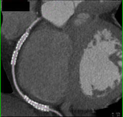 Stent in Right Coronary Artery (RCA) - CTisus CT Scan