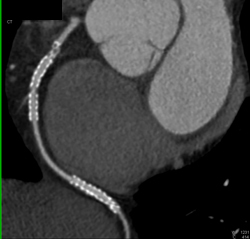 Stent in Right Coronary Artery (RCA) - CTisus CT Scan