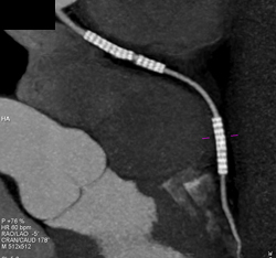 Stent in Right Coronary Artery (RCA) - CTisus CT Scan