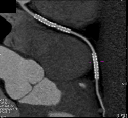 Stent in Right Coronary Artery (RCA) - CTisus CT Scan