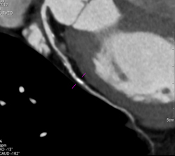 Left Anterior Descending Coronary Artery (LAD) Disease With Almost 50% Stenosis - CTisus CT Scan