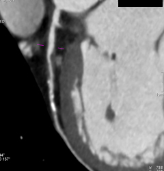 Left Anterior Descending Coronary Artery (LAD) Disease With Almost 50% Stenosis - CTisus CT Scan