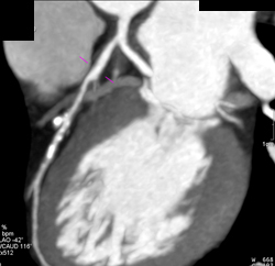 Left Anterior Descending Coronary Artery (LAD) Disease With Almost 50% Stenosis - CTisus CT Scan