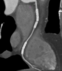 Stent in Right Coronary Artery (RCA) - CTisus CT Scan