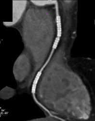 Stent in Right Coronary Artery (RCA) - Cardiac Case Studies - CTisus CT