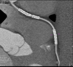 Stent in Right Coronary Artery (RCA) - CTisus CT Scan