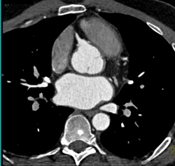 Dilated Origin of Reimplanted Right Coronary Artery (RCA) and Left Main Coronary Artery - CTisus CT Scan