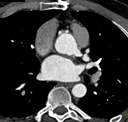 Dilated Origin of Reimplanted Right Coronary Artery (RCA) and Left Main Coronary Artery - CTisus CT Scan