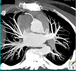 Dilated Origin of Reimplanted Right Coronary Artery (RCA) and Left Main Coronary Artery - CTisus CT Scan