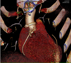 Dilated Origin of Reimplanted Right Coronary Artery (RCA) and Left Main Coronary Artery - CTisus CT Scan