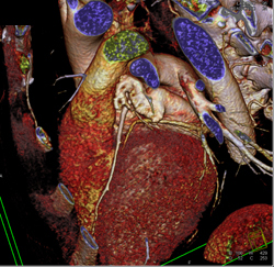 Dilated Origin of Reimplanted Right Coronary Artery (RCA) and Left Main Coronary Artery - CTisus CT Scan